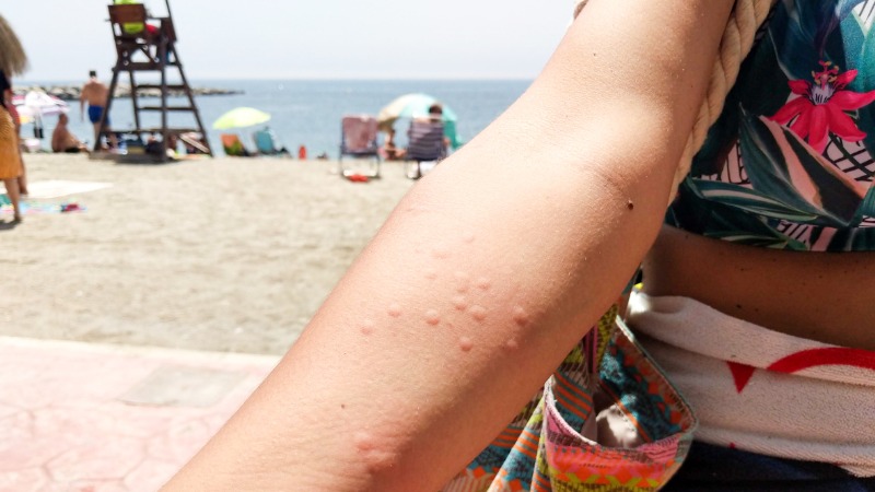 kwallenbeet symptomen bultjes